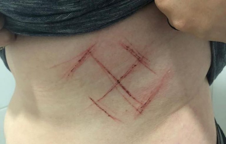 Mulher que alegou ter tido suástica marcada no corpo é indiciada por falsa comunicação de crime
