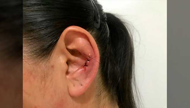 PM é mordida ao abordar jovem e leva 3 pontos na orelha