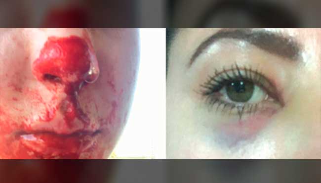 Mulher tem nariz quebrado após agressão do chefe do namorado