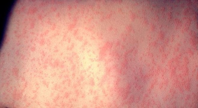 Brusque registra primeiro caso de sarampo em 20 anos
