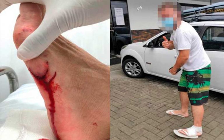 Surfista teve o pé mordido por tubarão mangona em Navegantes