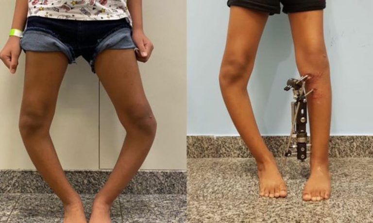 Técnica inovadora corrige deformidades nas pernas de crianças e jovens