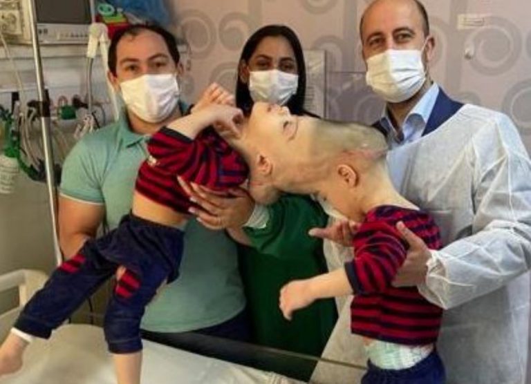 Gêmeos siameses unidos pela cabeça passam por cirurgia de separação
