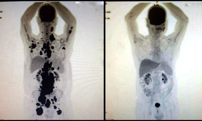 cancer-antes_depois-2
